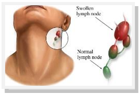 Illustration of swollen and normal lymph nodes in the human neck.